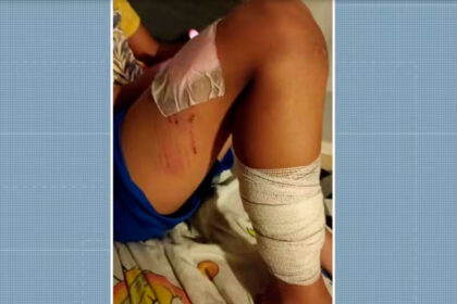 Crianças ficam feridas após ataque de pitbull em condomínio de Monte Mor-sindicolegal
